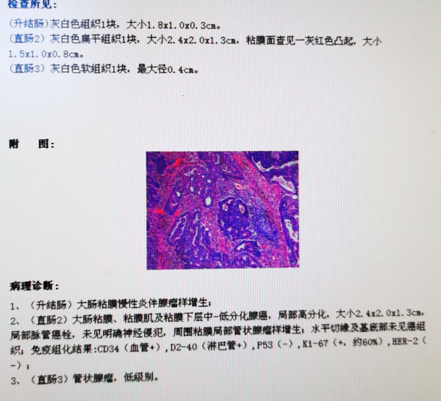 肠息肉切除手术危险,恶性肠息肉做微创一般住院几天