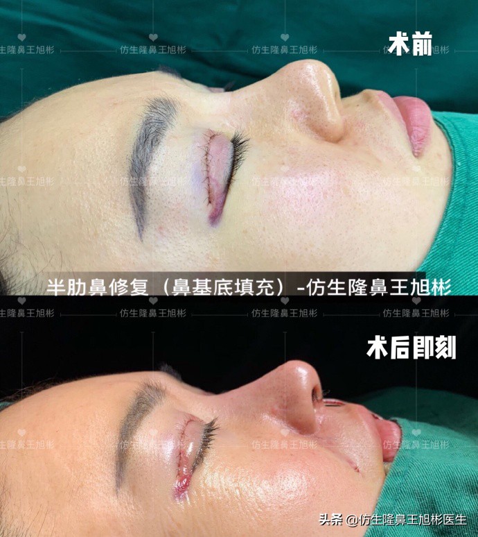 耳软骨隆鼻鼻小柱也是用耳软骨吗,耳软骨隆鼻可以摸到鼻尖的软骨吗