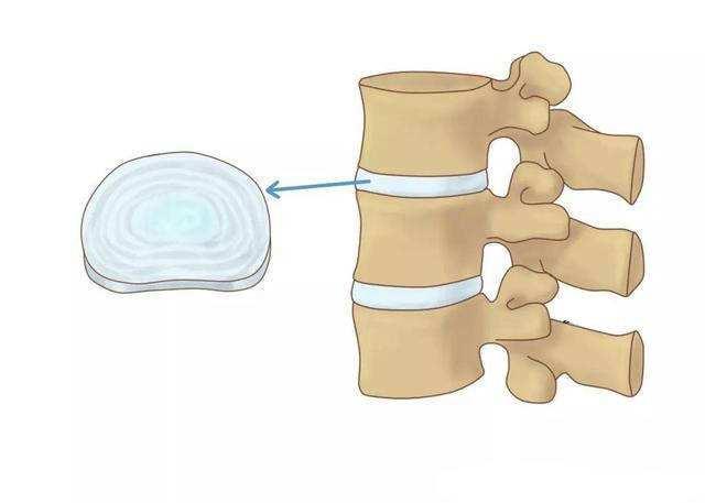 腰椎间盘膨出和滑脱手术会瘫痪吗,腰椎间盘膨出双下肢麻木会瘫痪吗