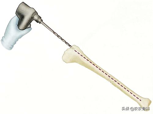 胫腓骨骨折髓内钉手术方式,髓内钉骨折最佳治疗方案