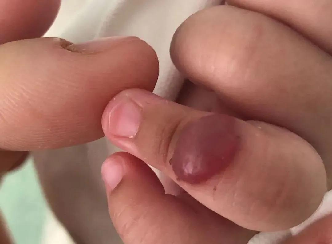 宝宝手指血管瘤治疗方法,手指头上长了个血管瘤怎么治疗