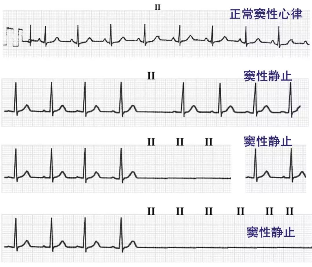 心律失常55分钟讲解,心律失常心电图讲解视频教程全集