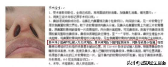 鼻中隔软骨隆鼻失败怎么修复,鼻中隔软骨隆鼻应注意什么