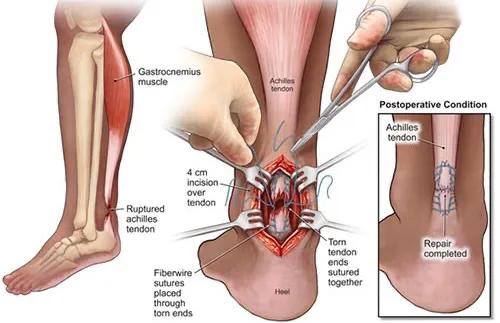 急性跟腱断裂怎么治疗