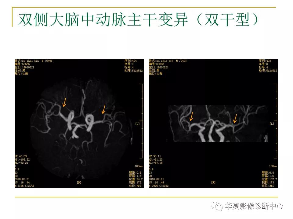 中国人脑立体定向mri应用解剖图谱,脑mri示意图