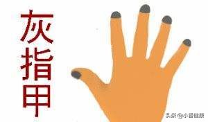 缺铁性贫血在指甲上的表现,缺铁性贫血指甲坑坑洼洼的怎么办