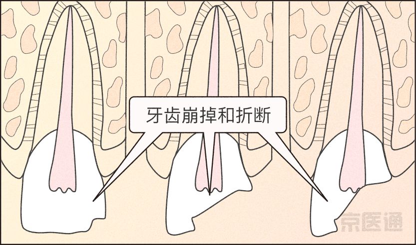 磨牙不好是真的吗,磨牙的危害与注意事项