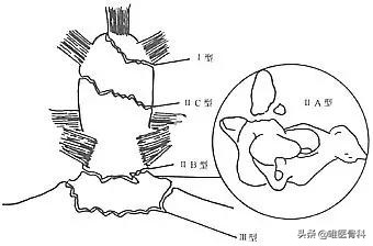 儿子脖子突然不敢往一面歪,孩子突然肩膀一高一低脖子歪