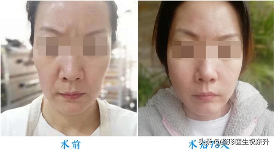 脸上的法令纹怎么去除,脸上有法令纹去除最好的方法