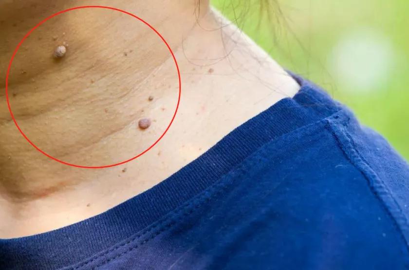 长瘊子会导致宫颈hpv感染吗,脚上长瘊子是身体有hpv病毒吗