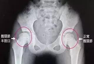 宝宝大腿纹不对称，要做哪些检查？