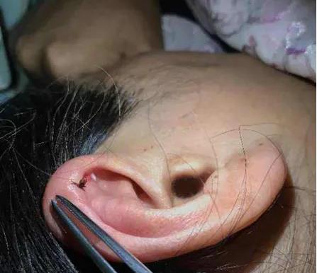 虫子叮咬引发疾病,虫子叮咬会得什么病