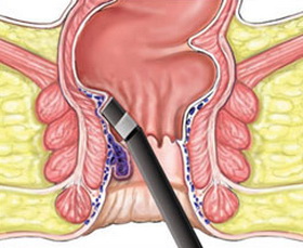 俗话说十人九痔真是那么回事吗,痔疮到底是个啥为什么说十人九痔