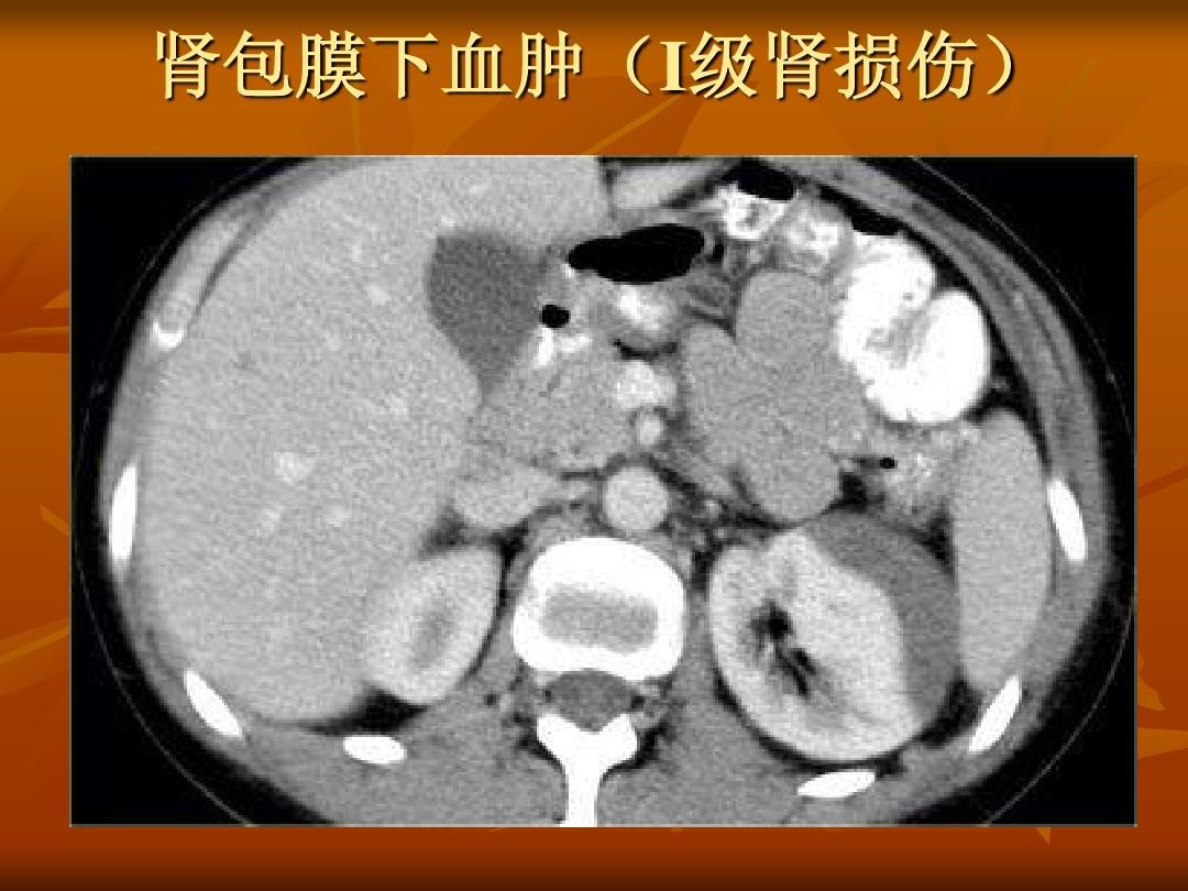 腹膜后血肿的并发症,外伤性腹膜后出血或血肿并发症