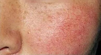 脸上有红血丝怎么办教你解决,脸上出现红血丝如何快速解决