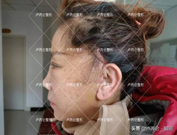 拉皮手术的后遗症有哪些,拉皮手术后易出现哪些后遗症