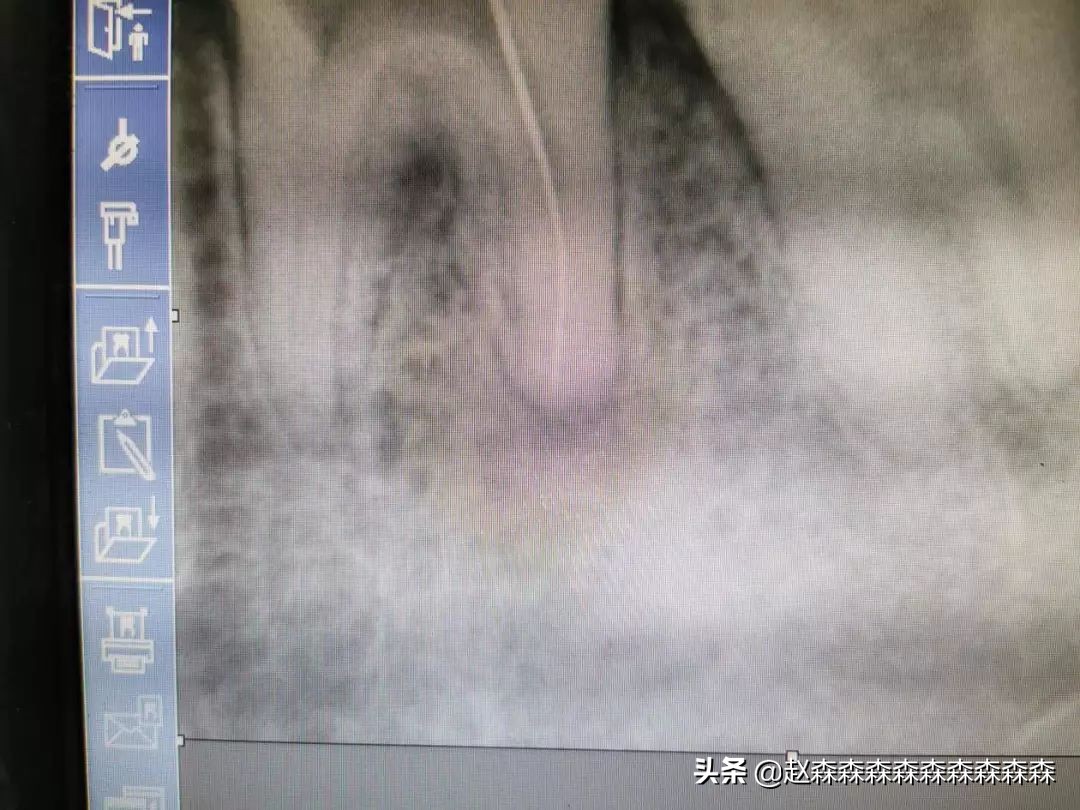 洗牙神器家用冲牙器测评,牙齿清洁神器冲牙器测评