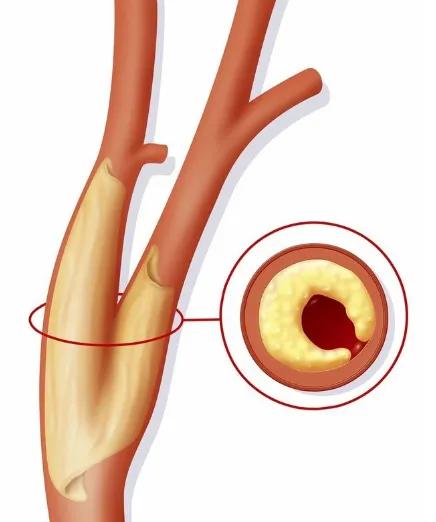 动脉斑块已形成是动脉硬化吗,动脉斑块钙化是好是坏