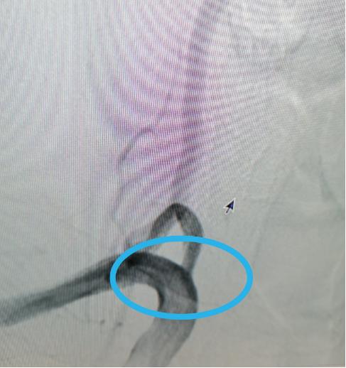 老人头痛怎么治疗最有效,通则不痛的最佳方法