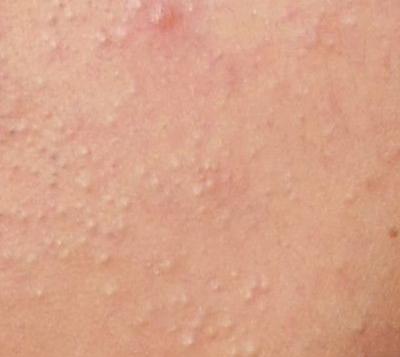 皮肤为什么会长痘长斑,皮肤为啥会长斑