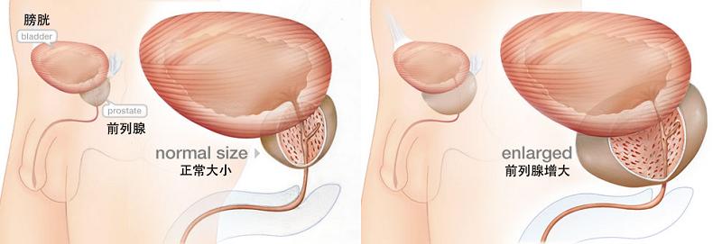 23岁前列腺肥大是什么原因引起,前列腺增生肥大吃什么缓解症状
