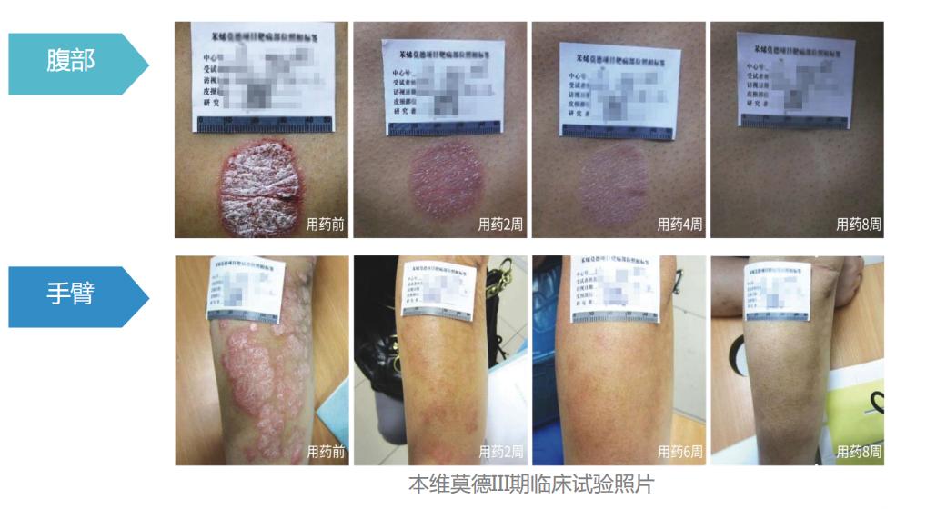 牛皮癣就是湿疹吗,牛皮癣是银屑病的一种吗