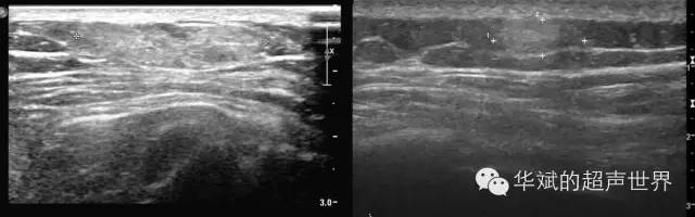纤维脂肪瘤属于什么类型的疾病,特殊类型脂肪瘤