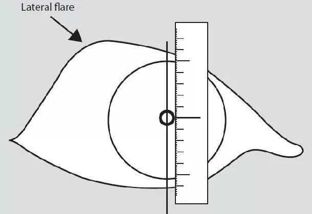 甲状腺眼病复视治愈率高吗,中医治疗甲状腺相关眼病