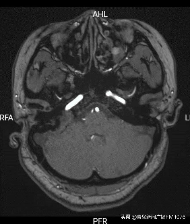 大妈脸不停抽搐,原是耳朵里藏了个大肿瘤,市立专家挑战高难度走位巧摘瘤