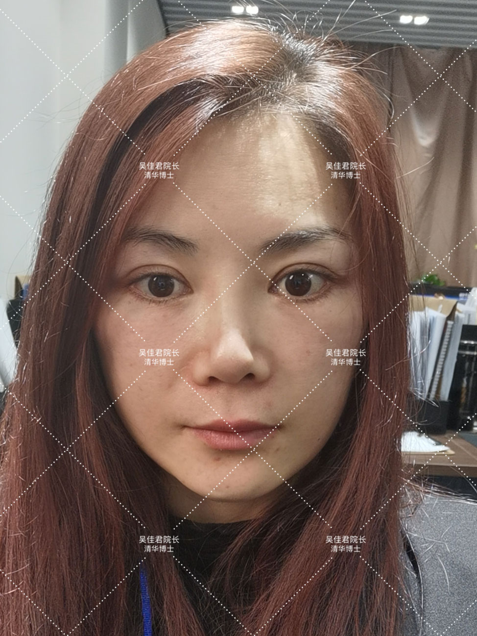 小拉皮术后恢复多久,小拉皮术后一个月发红