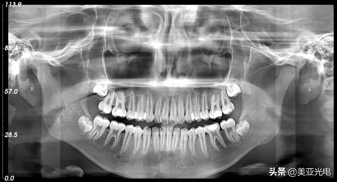 美亚口腔cbct全新局部ct功能上线,口腔cbct最好的品牌