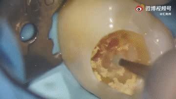 牙齿上有黑点可怕吗,牙齿上有小黑点原来这么可怕