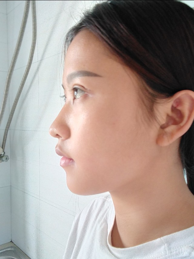 韩美做双眼皮,南昌韩美医院做双眼皮怎么样