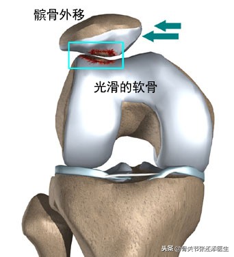 髌骨不舒服应该怎么锻炼,髌骨不肿可是疼怎么办