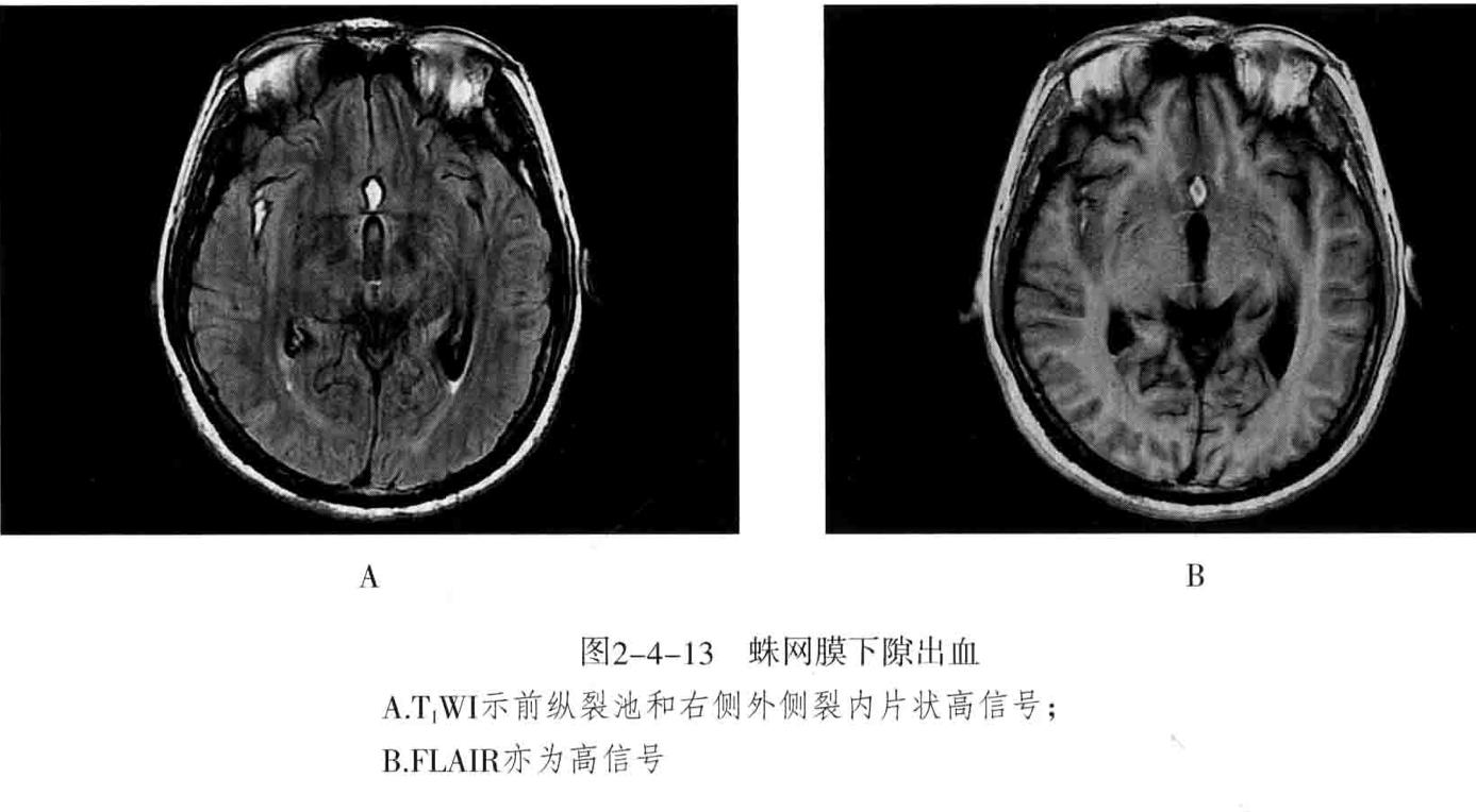 颅内血管轻度狭窄诊断标准,颅内血管先天变异影像