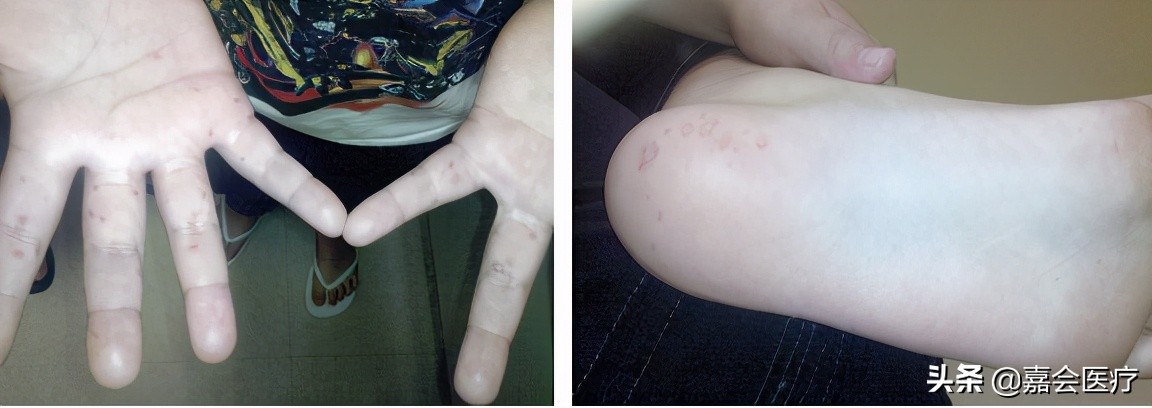 手足口病你必须知道,手足口病最新版知识解读