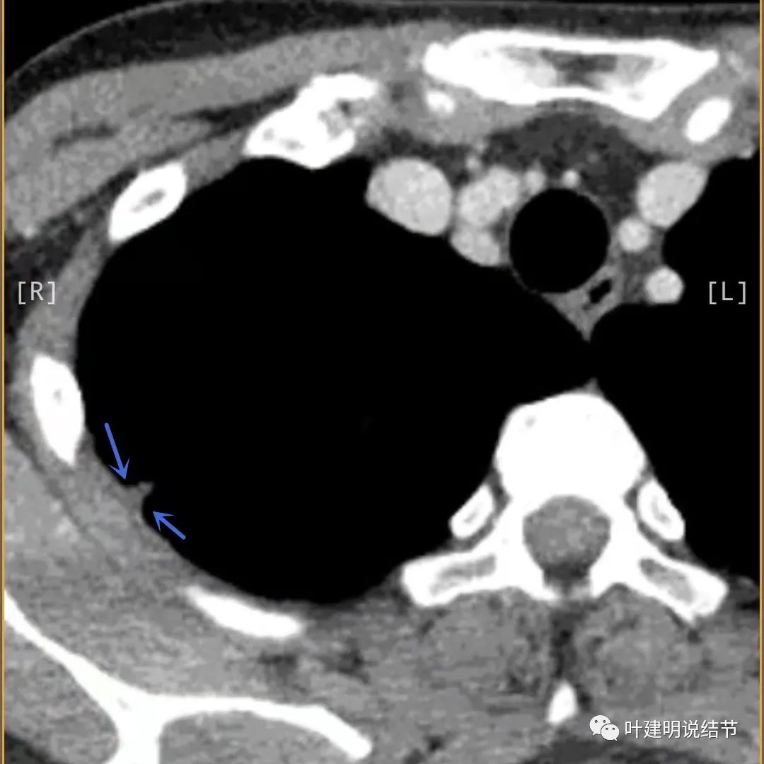 临床诊断孤立性肺结节,空洞型结节一般是什么性质