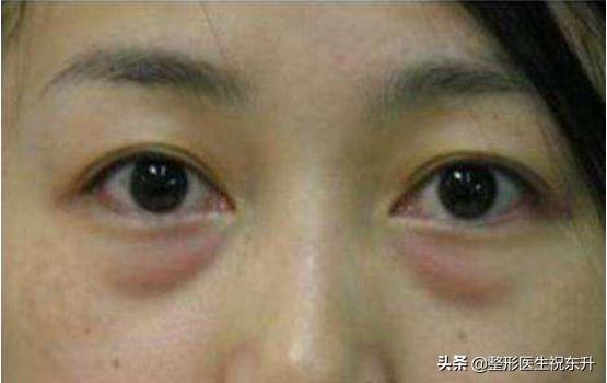 做眼袋用什么护肤品,眼袋大怎么办用什么眼霜好