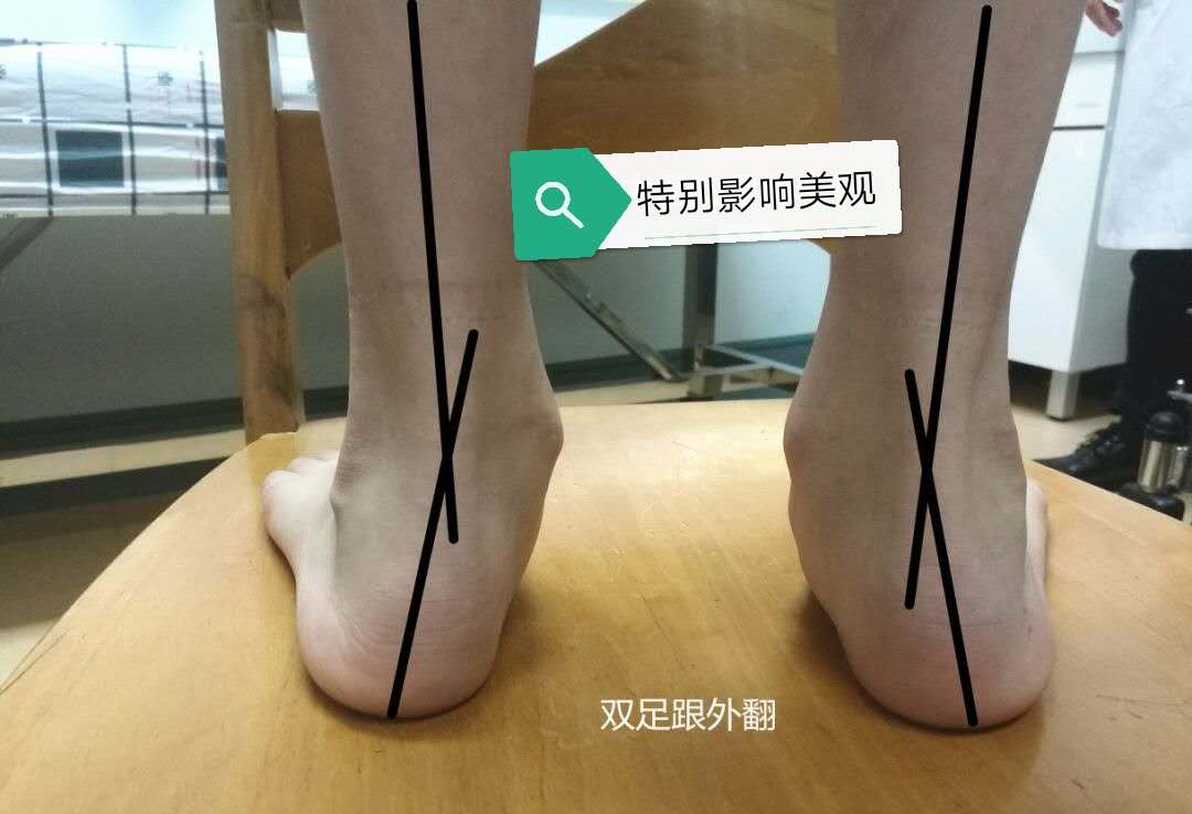 孩子脚跟疼是什么原因,孩子脚疼还肿怎么回事