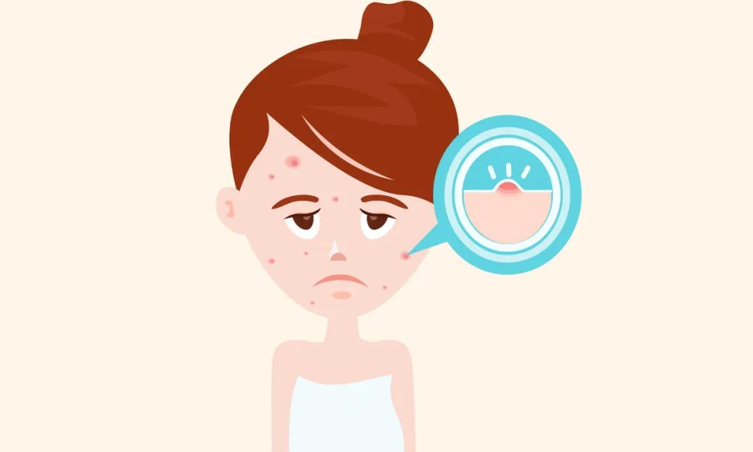 痘印痘坑毛孔粗大怎么消除,青春期留下的痘印痘坑怎么消除