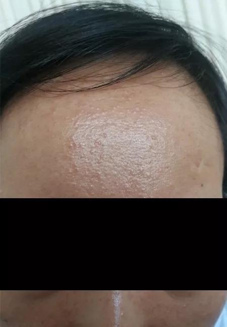 皮肤科医生告诉你，如何让痘痘不再复发