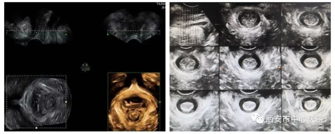 【大写的尴尬】大笑咳嗽时尿*禁失**了——四维超声带你认识盆底健康