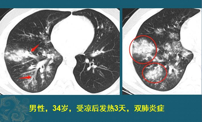 流感合并细菌感染时有什么症状,流感合并细菌感染可以治好吗