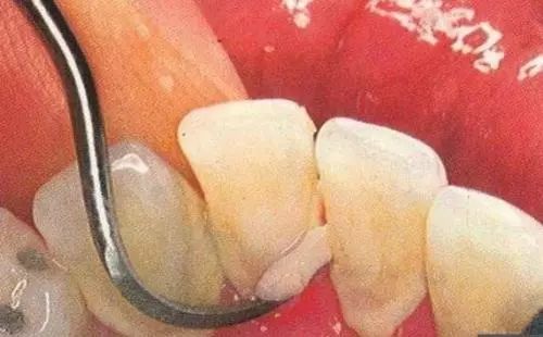 牙医眼中的洗牙竟然这么神奇,可以“包治口腔百病”