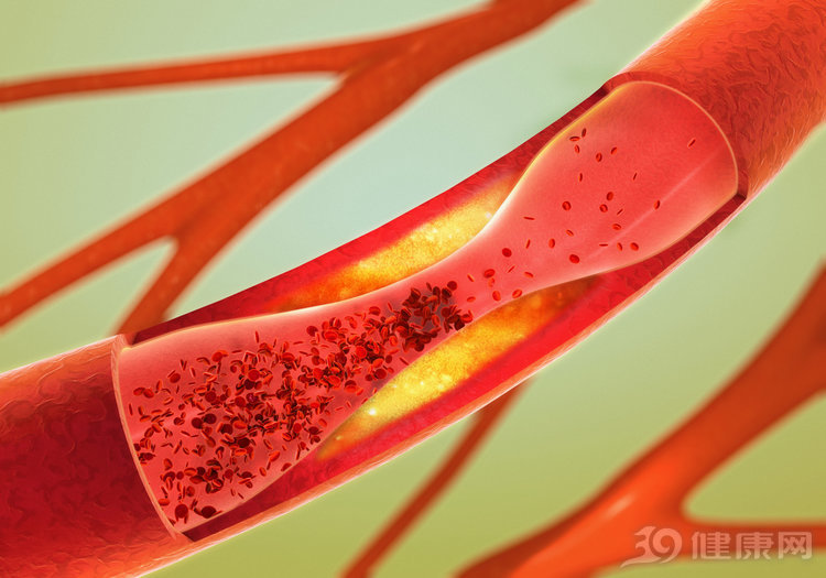 血管堵了，吃中药能治好吗？医生跟你交个实底