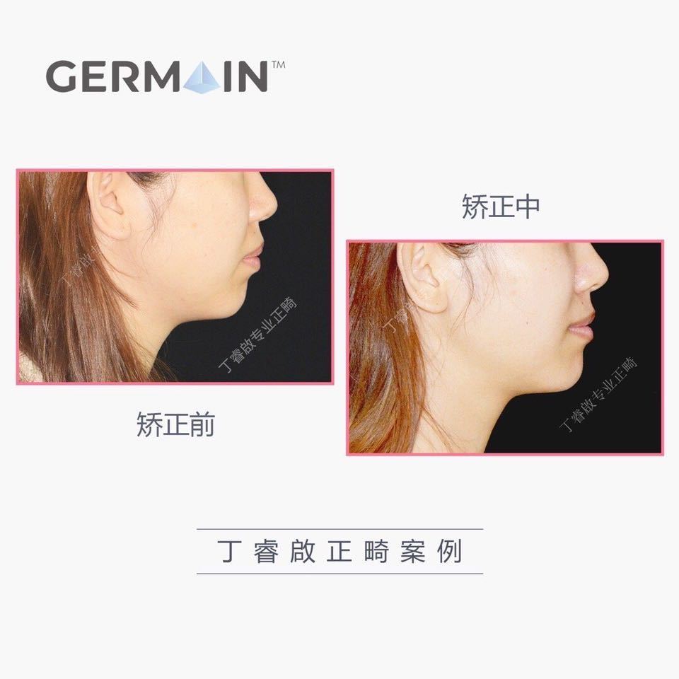 郑州牙齿矫正丁睿啟｜下巴后缩病例合集
