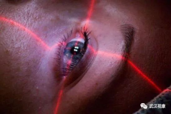 近视眼手术的发展史动画,近视眼手术发展史图片