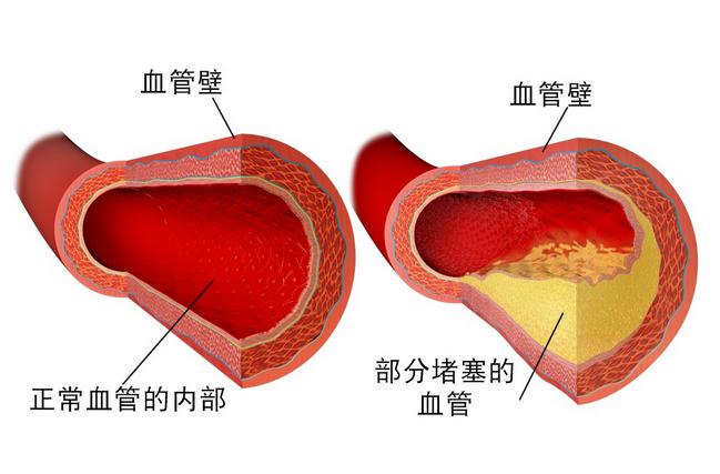 动脉硬化会导致心梗吗,如何防止动脉硬化或者心梗