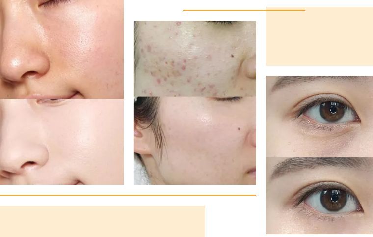 如何避免频繁戴口罩引起皮肤问题,戴口罩后护肤注意什么