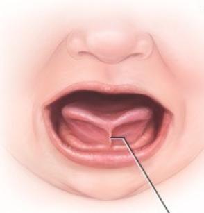 两岁半宝宝舌系带短必须手术吗,舌系带短两边还连着手术几天能好